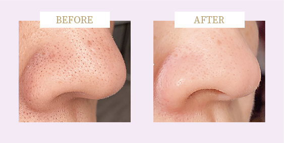 ビフォーアフタ