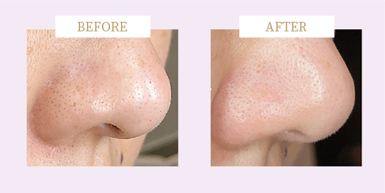 ビフォーアフタ